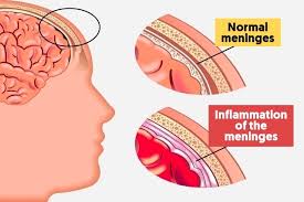 Meningococcal meningitis