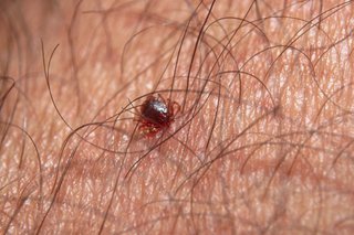 Tick Bourne Encephalitis