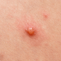 Chickenpox